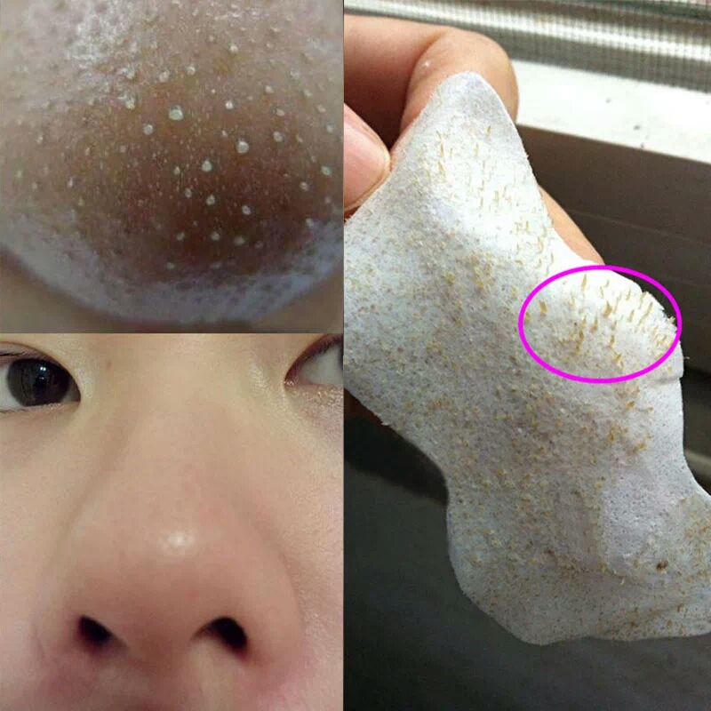 教你去黑头小妙招方法简单效果好,怎么用黑头针去除黑头