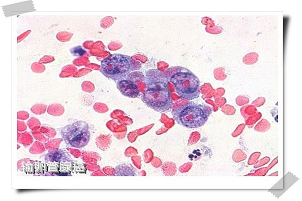 妇科的各种癌症诊断方法,妇科肿瘤诊断