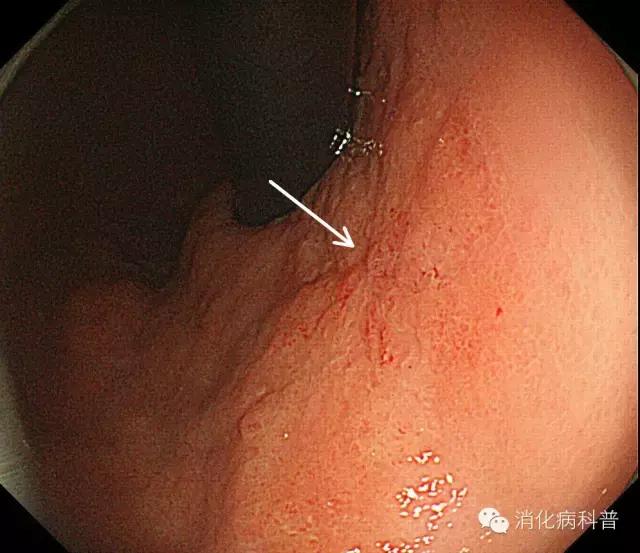 日本胃癌治愈率为什么高达80%,日本胃癌治愈率最高的药