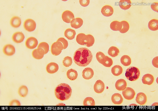 为什么急性炎症会引起白细胞增高?有一个特异指标直指细菌感染