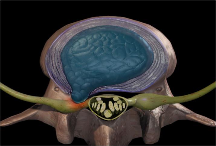 腰椎间盘突出能够恢复吗,腰椎间盘突出能够完全治好吗