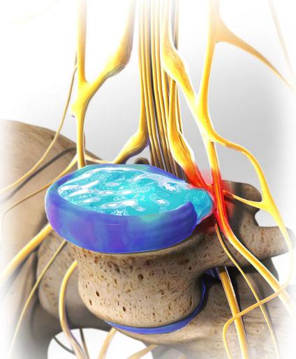 腰椎间盘突出能够恢复吗,腰椎间盘突出能够完全治好吗