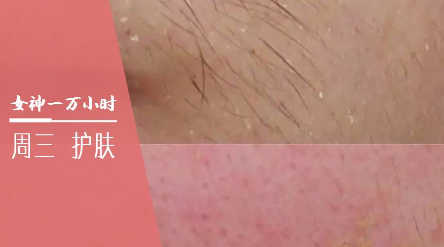 痘痘一直治不好的根本原因,痘痘是痤疮还是毛囊炎怎么判断