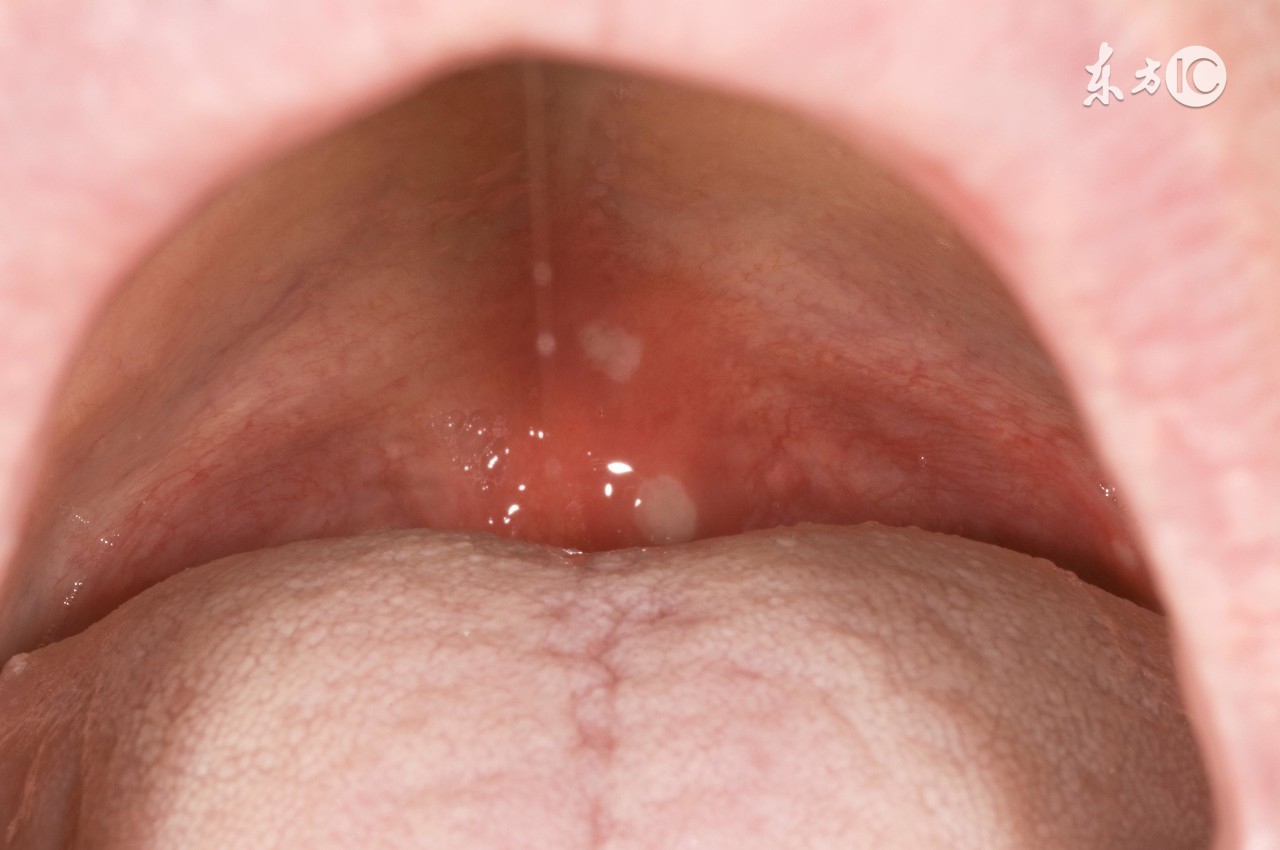 新生儿鹅口疮不管它会痊愈么,新生儿鹅口疮怎么能彻底清除