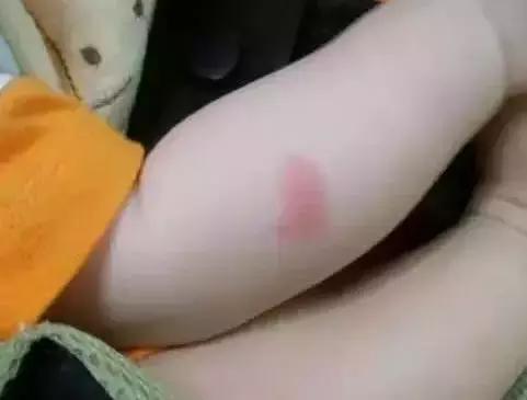 蚊虫叮咬后怎么止痒有效,蚊虫叮咬怎么有效止痒