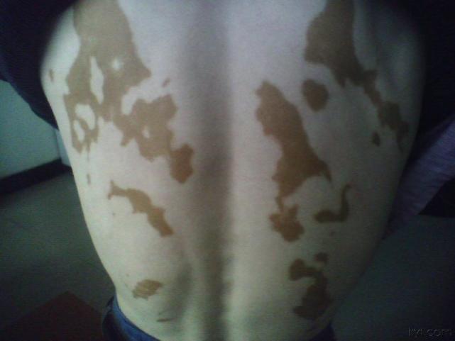 白癜风的人能吃些香菜吗,白癜风患者能吃哪些黑色素