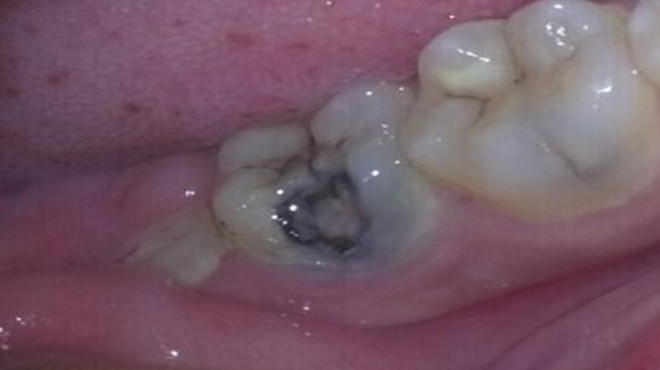 牙齿有黑洞怎么办?医生说这样做可缓解疼痛