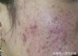 抗痘填坑,抗痘期间忌口大全