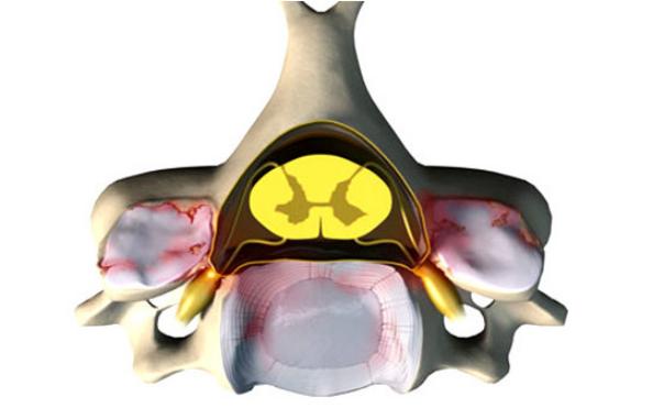 日本脊髓型颈椎病微创手术,脊髓型颈椎病保守治疗真实经历