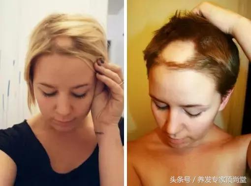 前额脱发还能恢复吗,脱发两年还能恢复吗