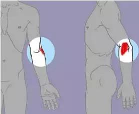 胳膊肘疼怎么办如何缓解,胳膊肘疼怎么办小妙招视频