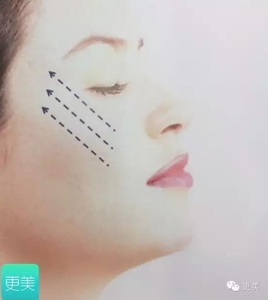 脸部缝美容线好还是普通线好,医院埋线和美容院埋线有什么差别