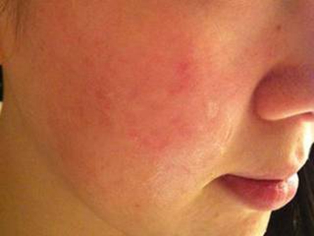 季节性过敏的皮肤该怎么办,季节性皮肤过敏怎么护肤