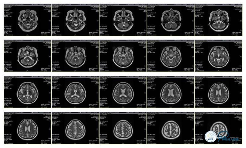 脑静脉窦狭窄做支架危险吗,静脉窦狭窄做支架后多久恢复