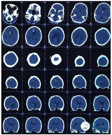 脑静脉窦狭窄做支架危险吗,静脉窦狭窄做支架后多久恢复