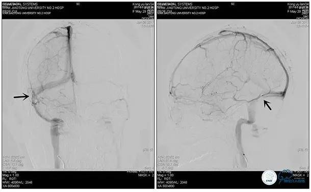 脑静脉窦狭窄做支架危险吗,静脉窦狭窄做支架后多久恢复