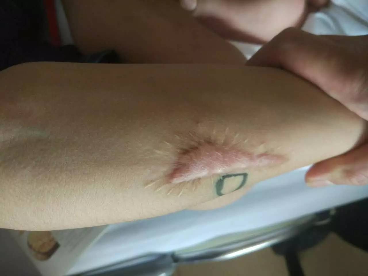 10年的手术疤痕,十年的手术疤痕