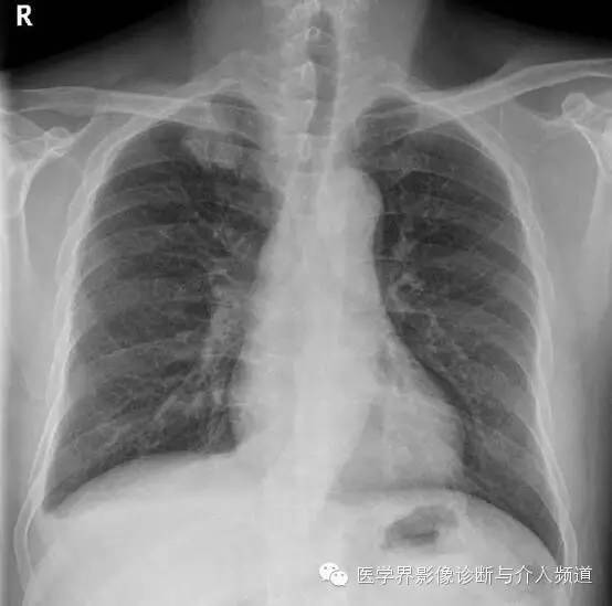 咳嗽排除了肺部的问题,咳嗽为什么比不咳好