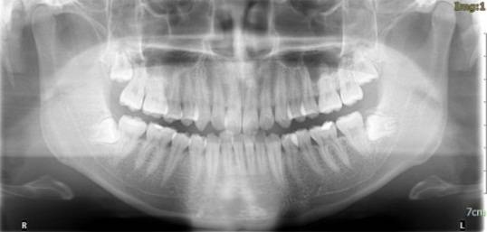 龅牙地包天怎么弄,龅牙怎么解决最好