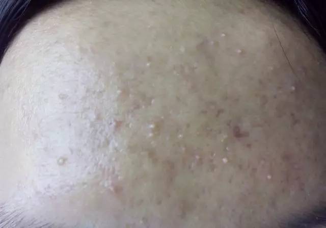 十年战痘血泪史详解,战痘知识分享