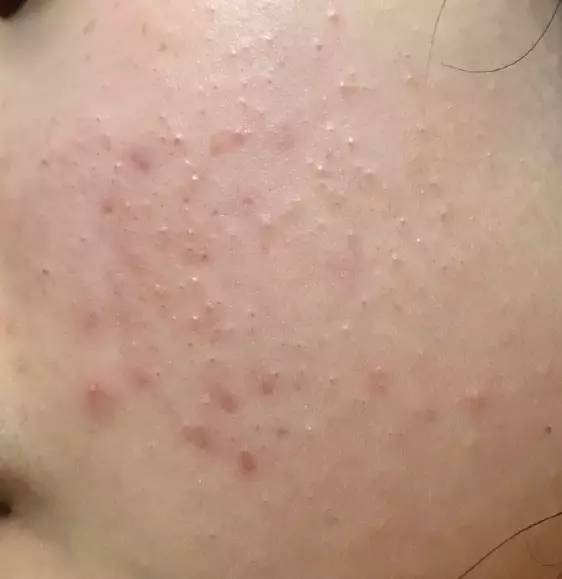 战痘合集完整版,战痘大结局完整版