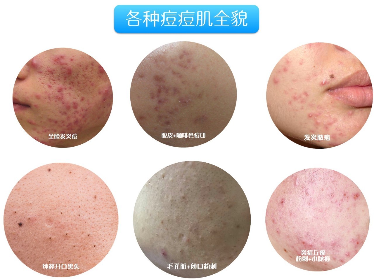 战痘合集完整版,战痘大结局完整版