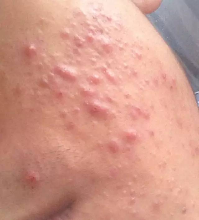 十年战痘血泪史详解,战痘知识分享