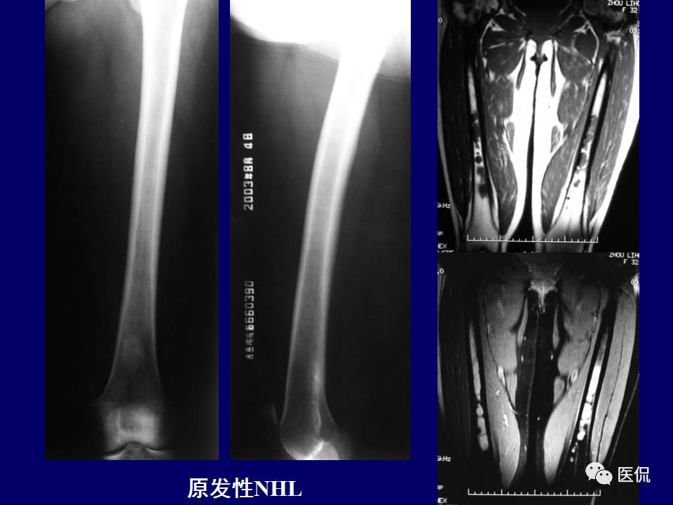 徐文坚老师精讲：原发性骨淋巴瘤影像学诊断医学影像精品PPT
