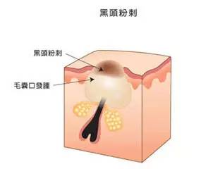 战痘合集完整版,战痘大结局完整版