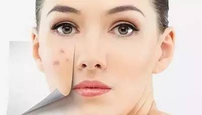 乌鲁木齐祛痘痘最好的地方,乌鲁木齐专业消除痘痘