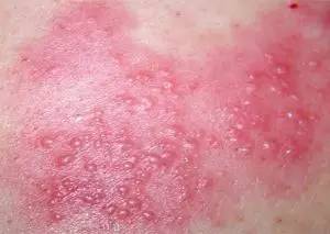 身上有一道道红印是荨麻疹,河北省二院治疗荨麻疹好吗