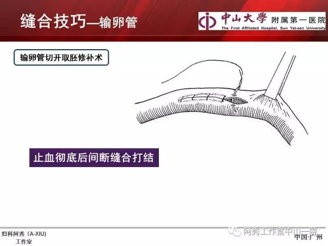 妇科腹腔镜下常用缝合技巧