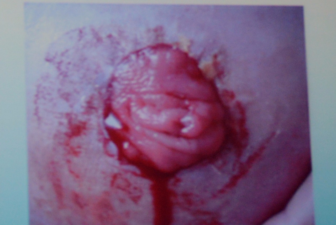 肠造口常见周围皮肤并发症,肠造口护理操作并发症