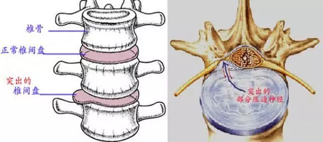 腰椎间盘突出不治会导致瘫痪吗,腰椎间盘突出拖久了会怎样