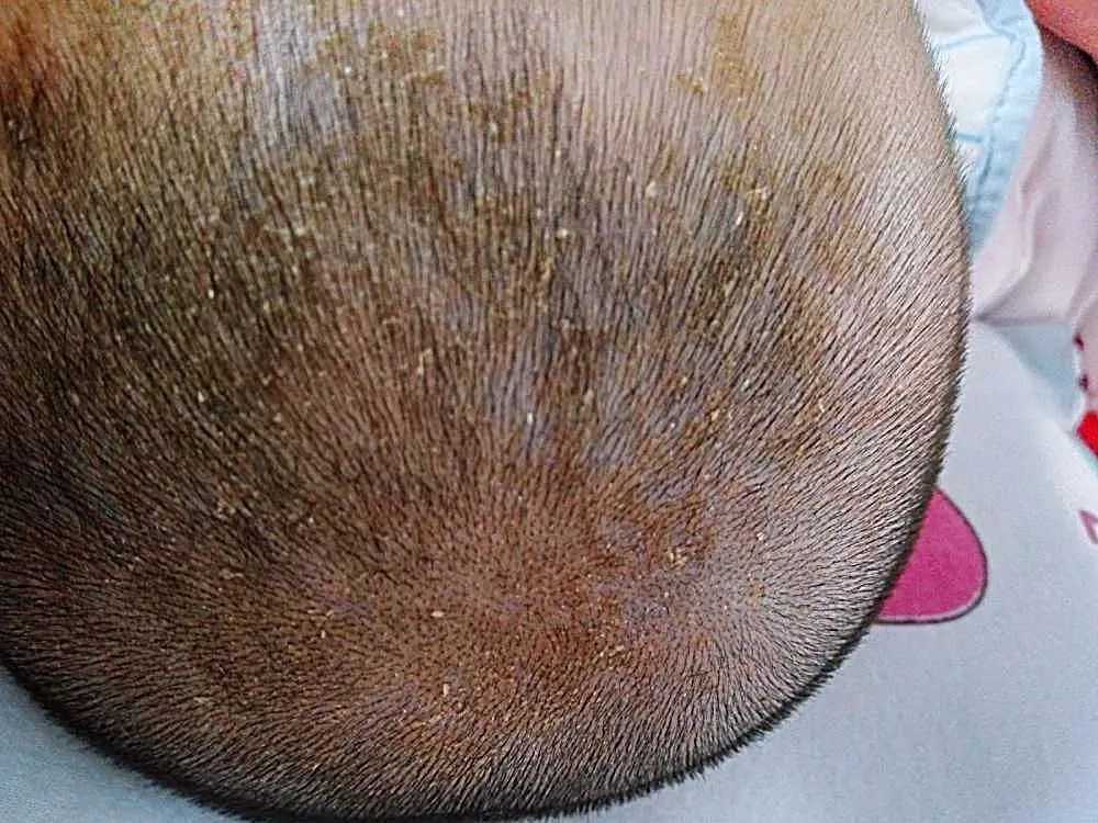 宝宝头上有凸起抠下来硬硬的结痂,婴儿头皮上的乳痂要抠掉吗