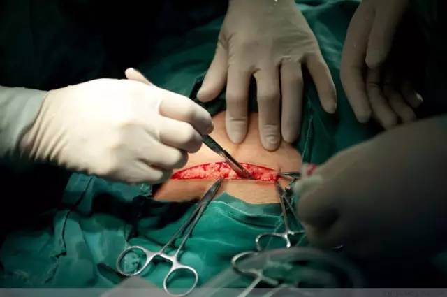 剖腹产全景记录,剖腹产恢复不同时期的照片