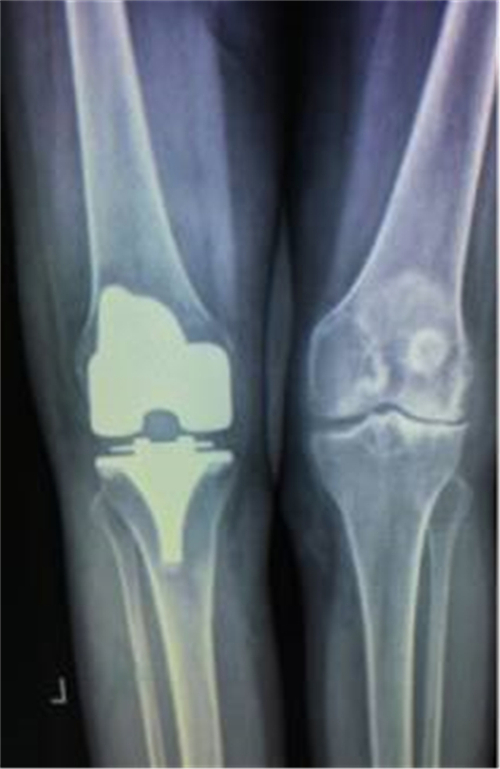 郴州市关节置换,湘雅附二膝关节置换手术