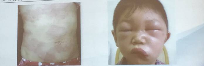 幼儿麻疹的鉴别方法,儿童麻疹的诊断与治疗