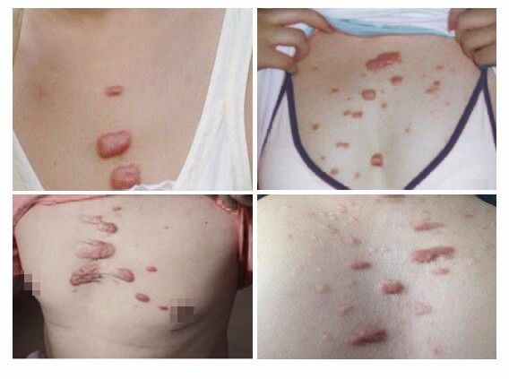 轻微毛囊炎能自愈吗,毛囊炎警惕什么疾病