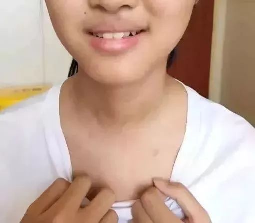 甲状腺术后没有引流管,甲状腺术后伤口不愈合是什么原因