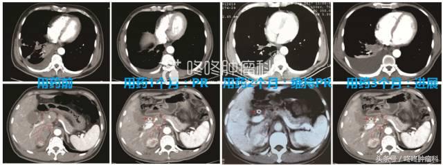 吴一龙pd1单抗免疫治疗,吴一龙谈靶向治疗最新消息