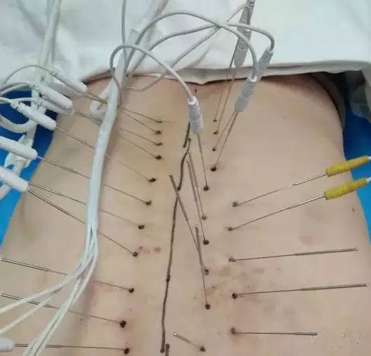 射频消融术和内热针有什么区别,内热针疗法治疗腰间盘突出