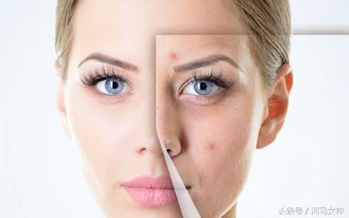 抗痘填坑,抗痘期间忌口大全