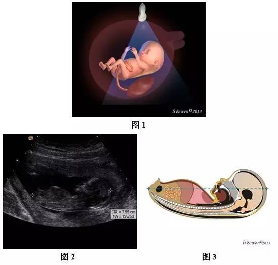 孕26周进行胎儿超声心动图检查,孕11-14周胎儿超声检测报告
