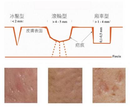 如何修复毛孔粗大和痘坑,痘坑痘印毛孔粗大的区别