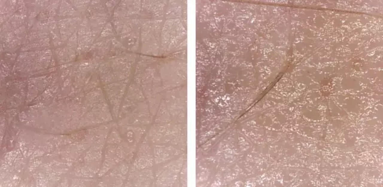 美容院提拉效果最好的美容仪器,好的美容仪器的作用