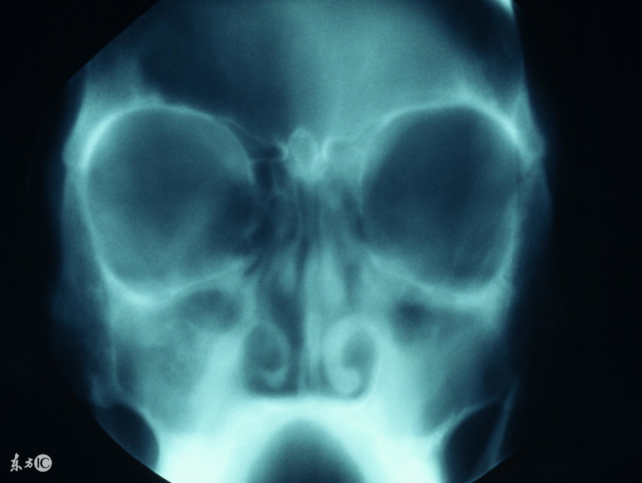 鼻窦炎的危害有多大,鼻窦炎拍ct的危害有什么