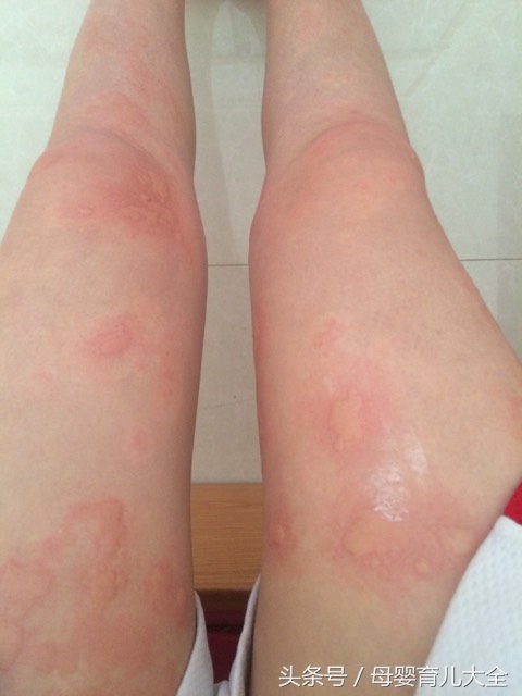 回了趟老家身上起疙瘩,小孩回农村老家身上长疙瘩非常痒