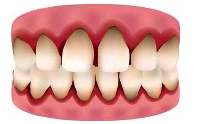 舒卿治疗牙疼牙龈肿痛,治疗牙龈肿痛的小方法