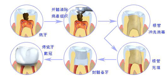坐飞机牙疼怎么缓解,坐飞机牙痛是怎么回事